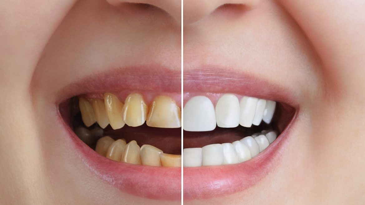 Blanqueamiento dental, ¿en qué consiste?