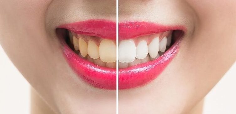 ¿Por qué tengo los dientes amarillos?