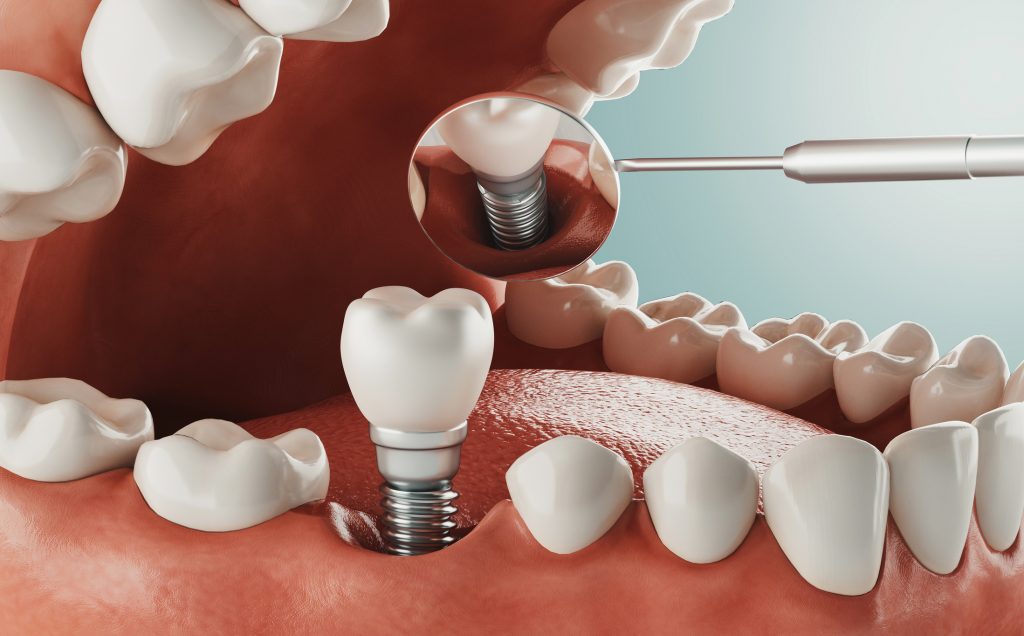 Ventajas de llevar implantes dentales