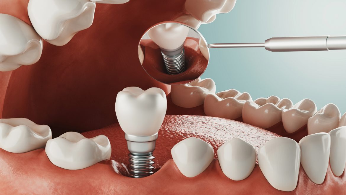 Ventajas de llevar implantes dentales